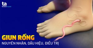 Bệnh giun rồng: Nguyên nhân, dấu hiệu và các biện pháp điều trị