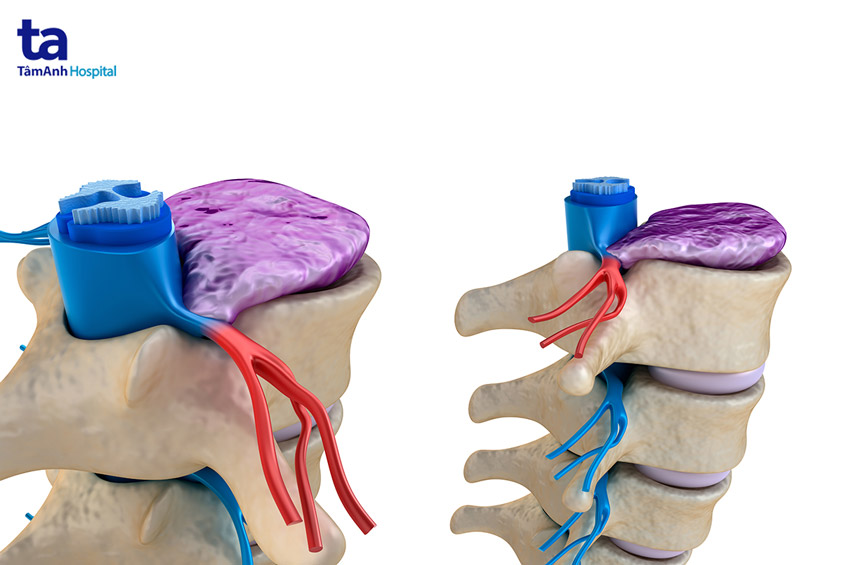 bệnh lý đĩa đệm