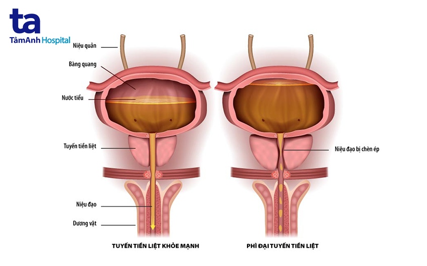 bệnh tuyến tiền liệt