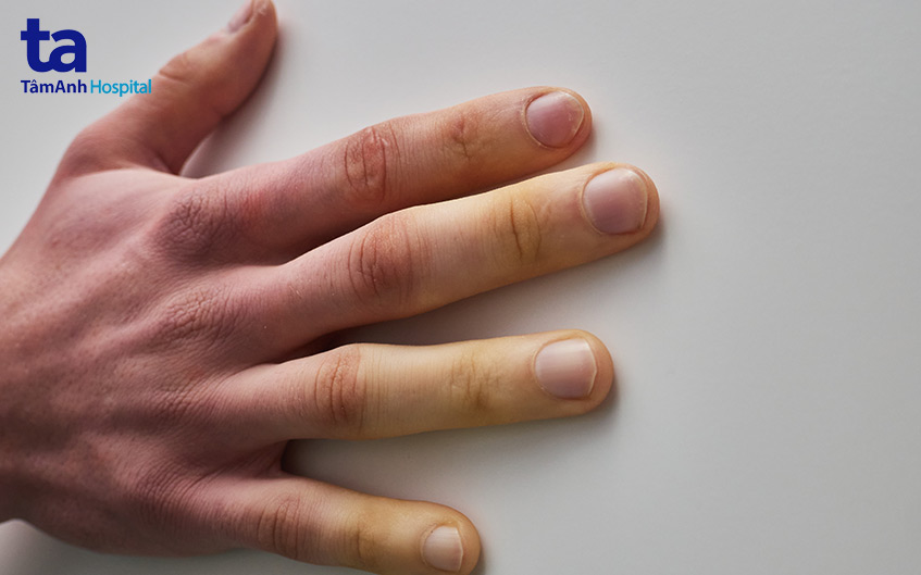 biểu hiện của xơ cứng bì hệ thống