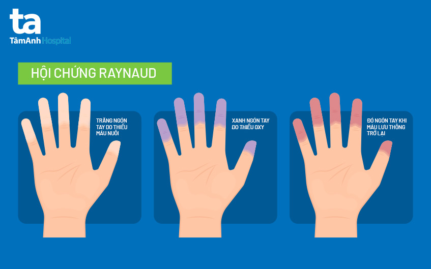 căn bệnh raynaud