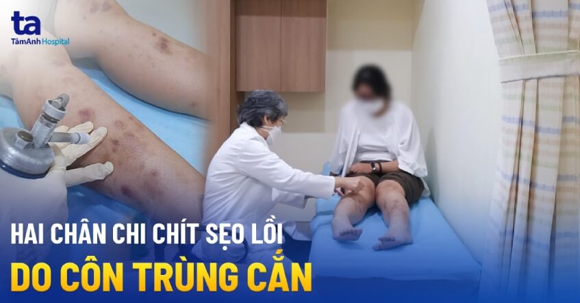 Đi cắm trại, hai chân chi chít sẹo lồi do côn trùng cắn