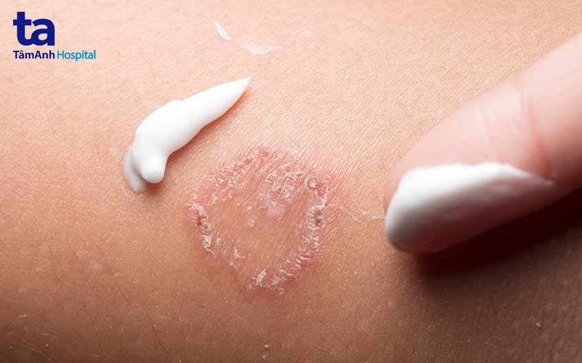 thuốc bôi da
