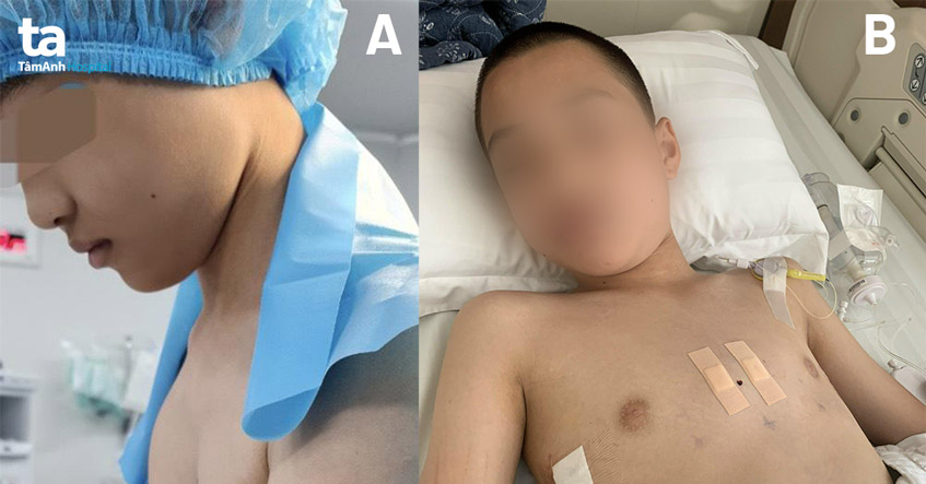 Phẫu thuật nội soi nâng ngực cho bé trai bị lõm ngực bẩm sinh