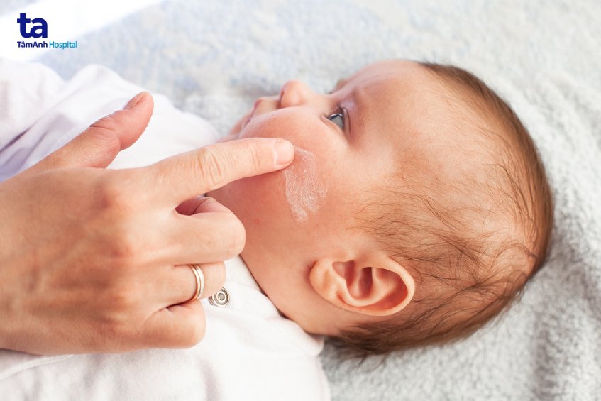Cách điều trị bệnh viêm da cơ địa ở trẻ em