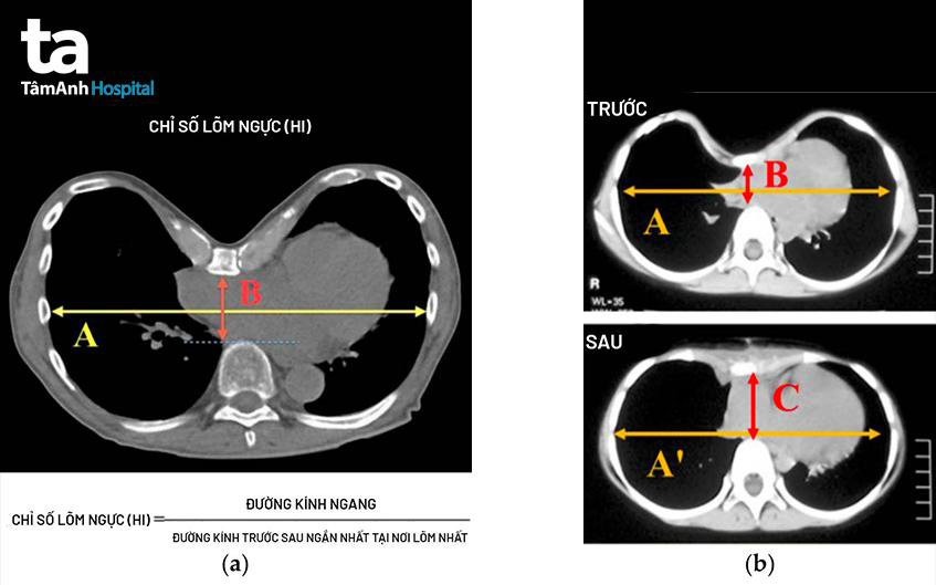 chỉ số lõm lồng ngực