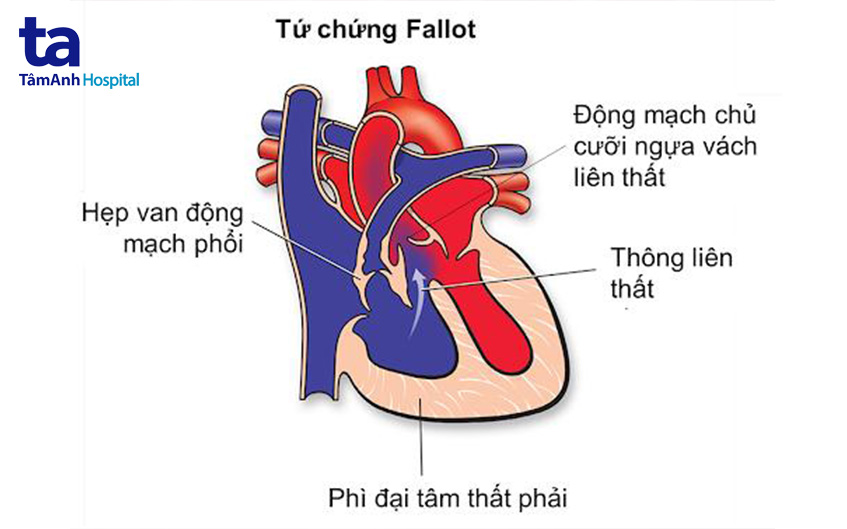 dị tật tứ chứng fallot 4 bẩm sinh