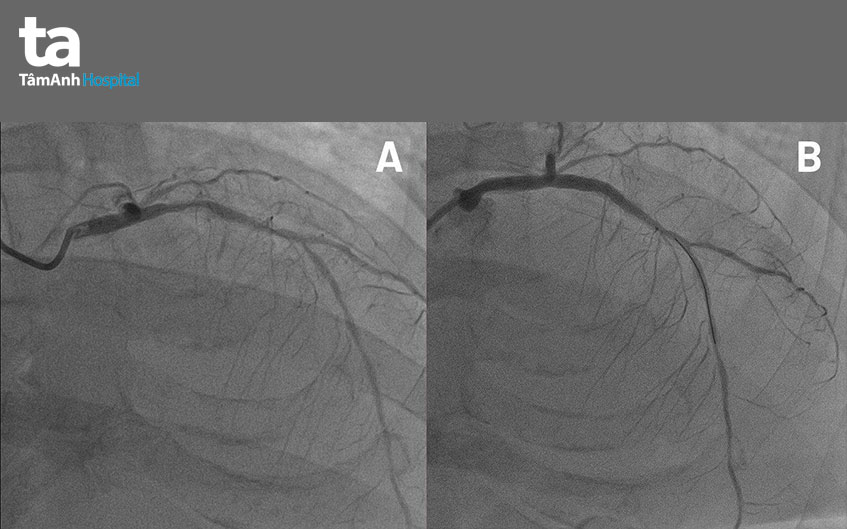 hình ảnh chụp động mạch vành