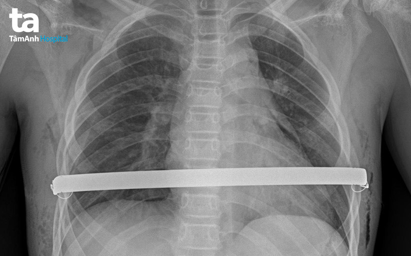 hình ảnh x quang lồng ngực bị lõm