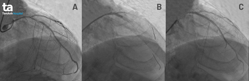 hình chụp mạch vành