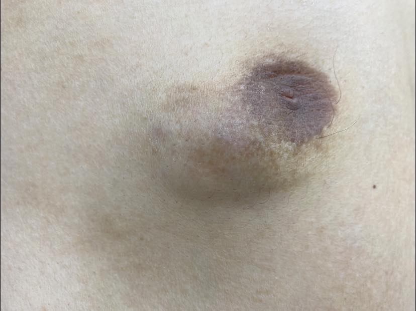 Khối u vú lồi lên và bề mặt sần vỏ cam trên da của người đàn ông.