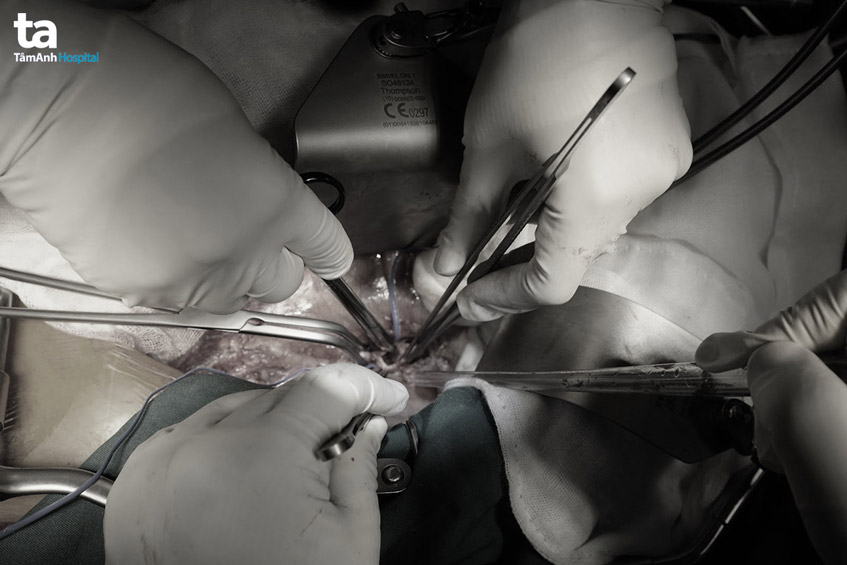 kỹ thuật ghép mạch