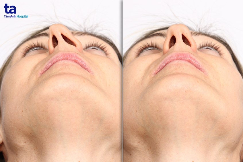 lệch vách ngăn mũi gây viêm mũi