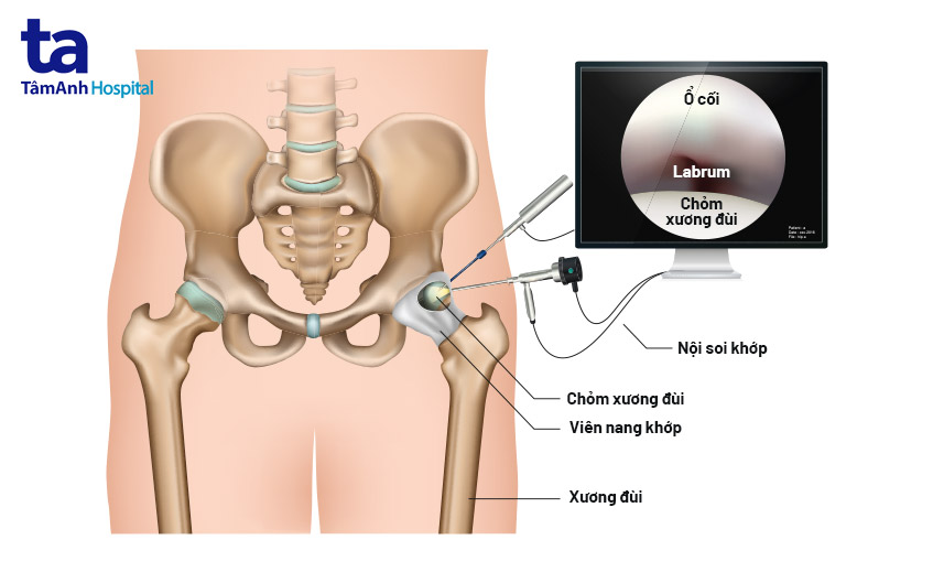 quy trình nội soi khớp háng