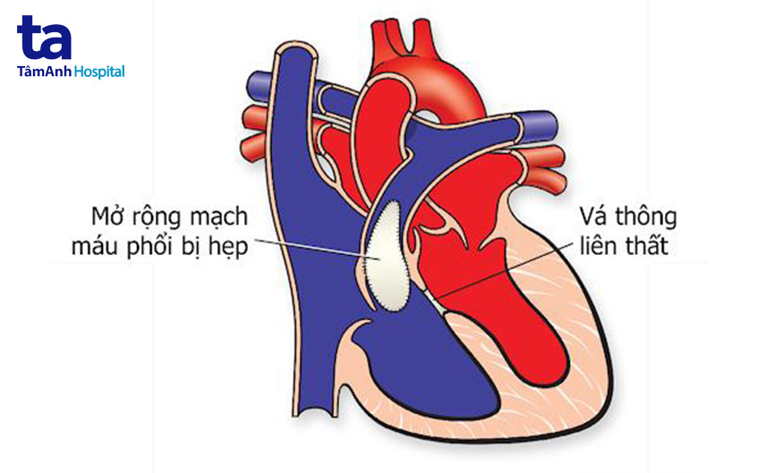 sữa chữa dị tật thông liên thất