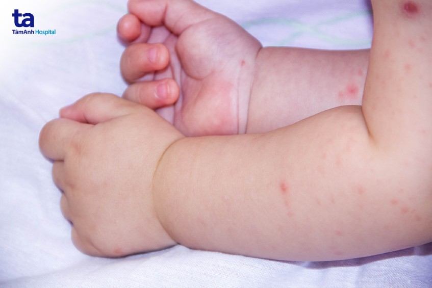 Trẻ bị tay chân miệng kiêng gì