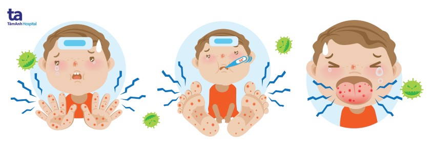 Triệu chứng và biến chứng bệnh tay chân miệng ở trẻ