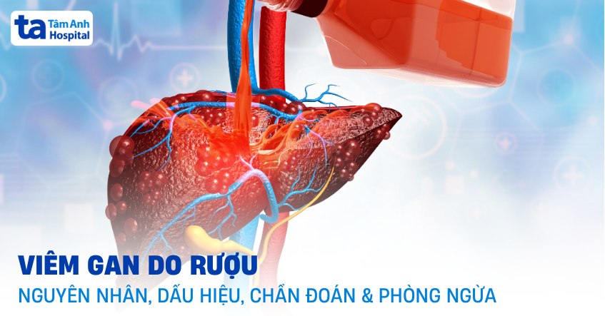 viêm gan do rượu