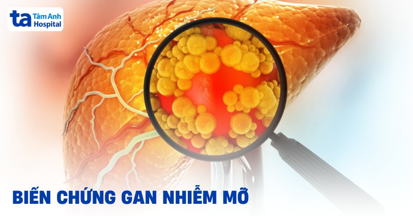 6 biến chứng gan nhiễm mỡ nguy hiểm, gây nhiều tác hại không ngờ