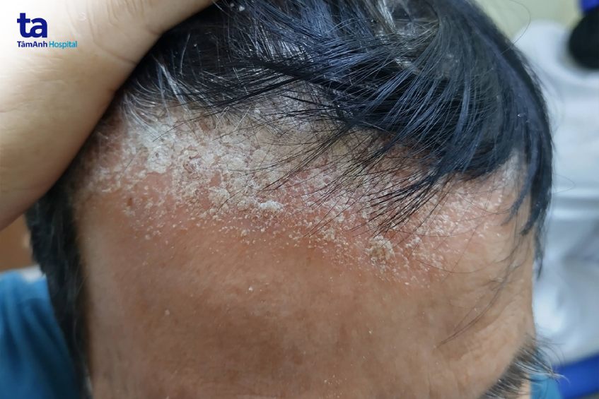 các mãng gàu dày