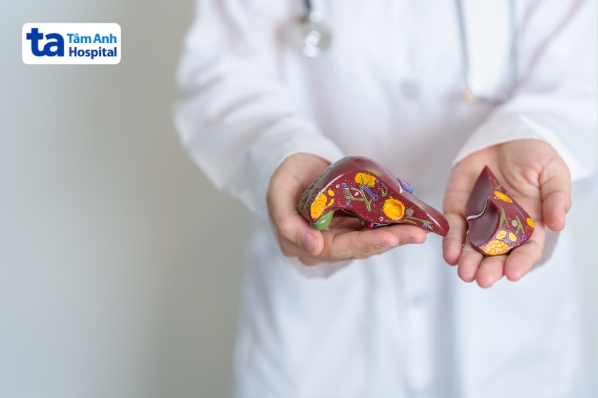 chữa viêm gan do rượu