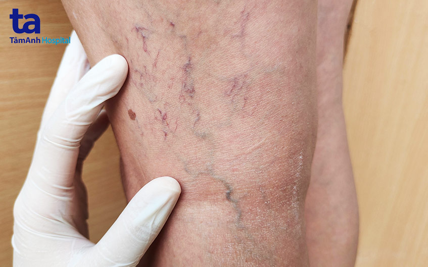 đám rối tĩnh mạch chân