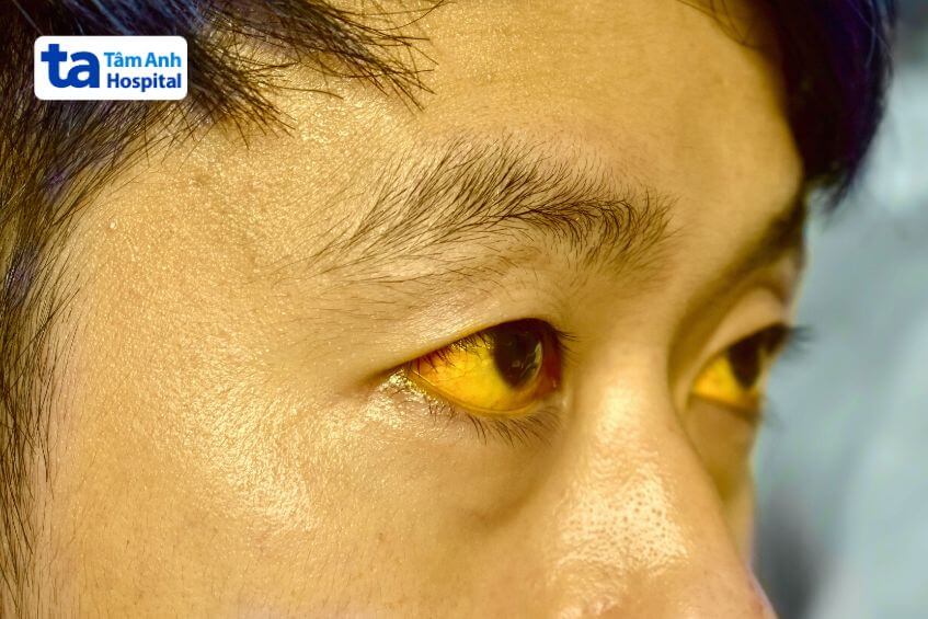 dấu hiệu viêm gan do rượu