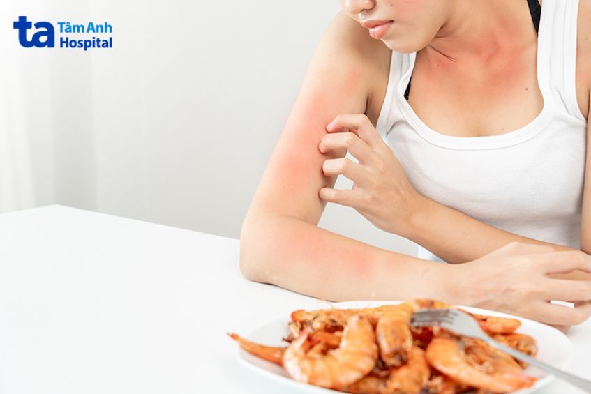 Nổi mề đay do dị ứng hải sản