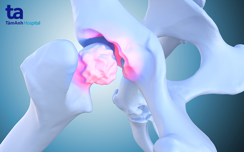 điều trị bệnh lý khớp háng