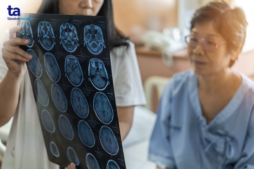điều trị bệnh u não