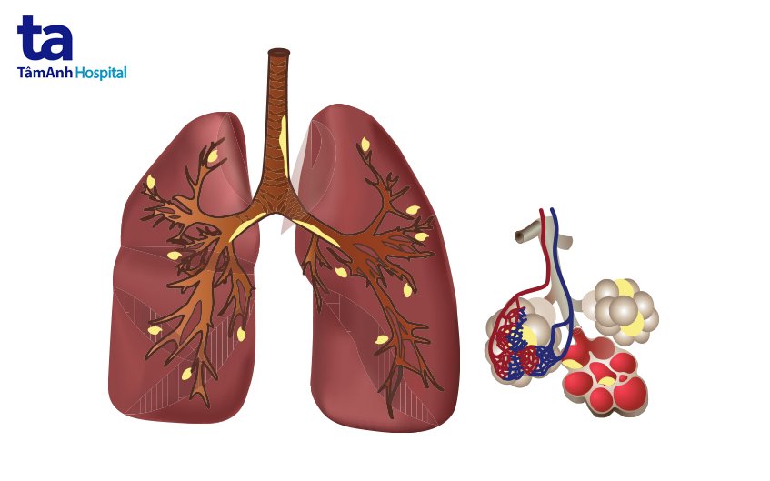 Triệu chứng viêm phế quản phổi