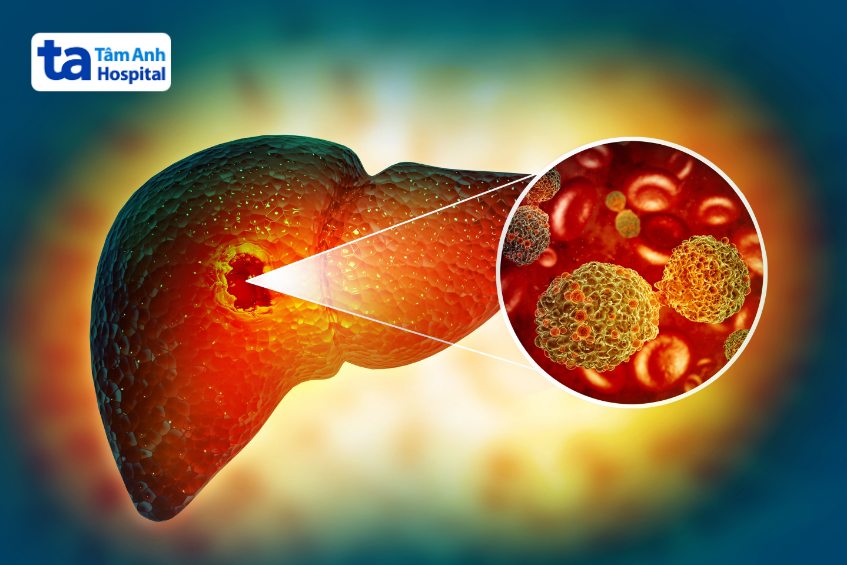 gan nhiễm mỡ có biến chứng gì