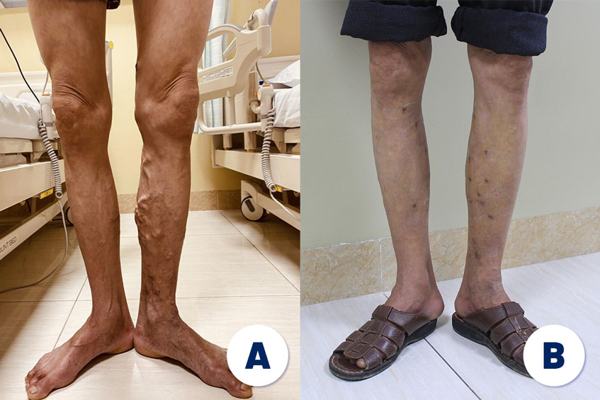hình ảnh chi dưới của bệnh nhân