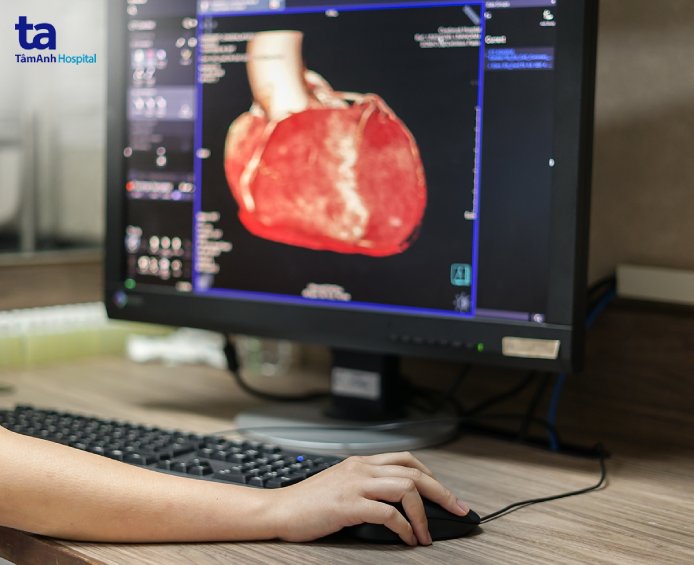 kỹ thuật chụp ct tầm soát đột quỵ tim