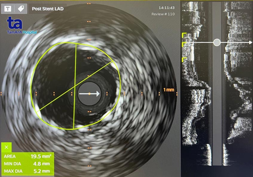 lòng động mạch liên thất