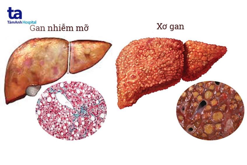 nguyên nhân gây gan to