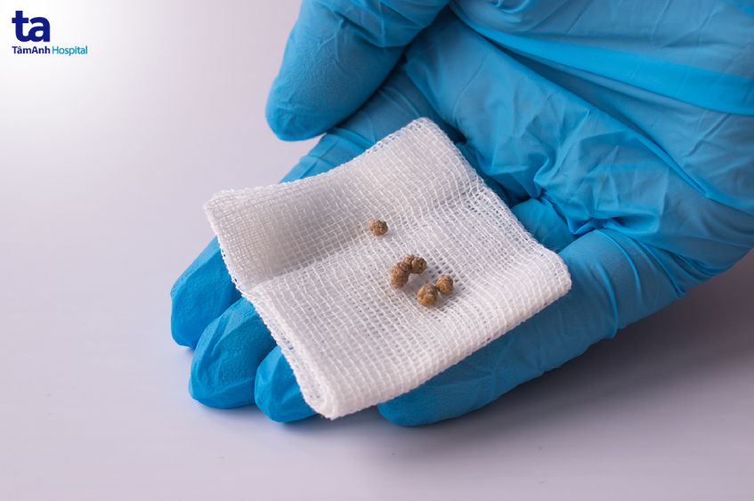 siêu âm bàng quang phát hiện bênh gì