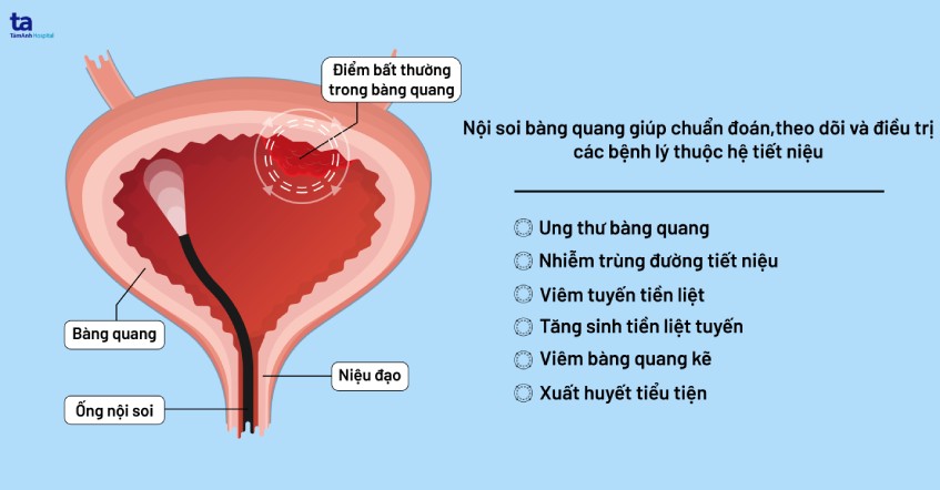 soi bàng quang