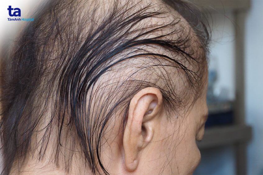 tác dụng phụ của điều trị u não