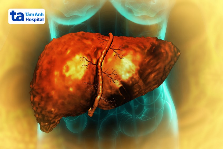 tác hại của gan nhiễm mỡ