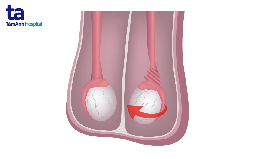 Tinh hoàn lạc chỗ có thể gây xoắn tinh hoàn