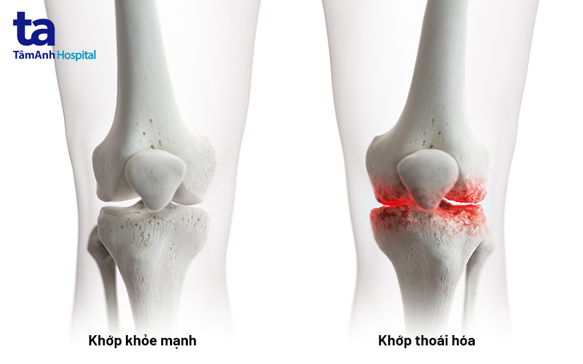 trường hợp khớp gối bị thoái hóa
