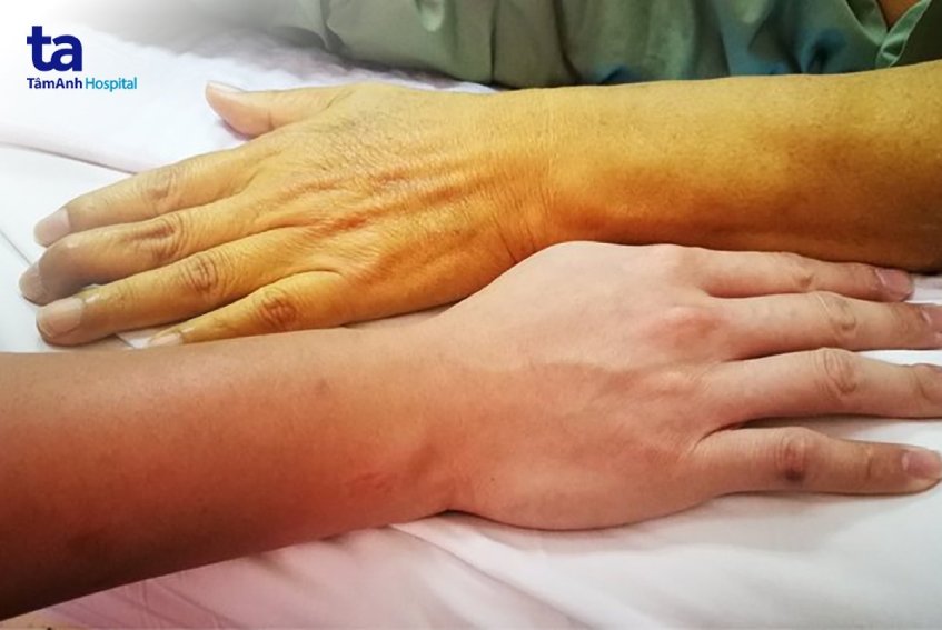 Vàng da là biểu hiện men gan tăng cao