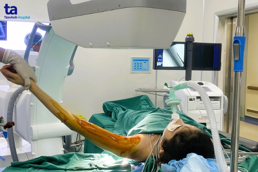 xác định chính xác vị trí của que