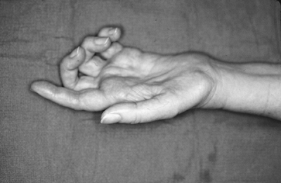 Liệt thấp thần kinh trụ và thần kinh giữa