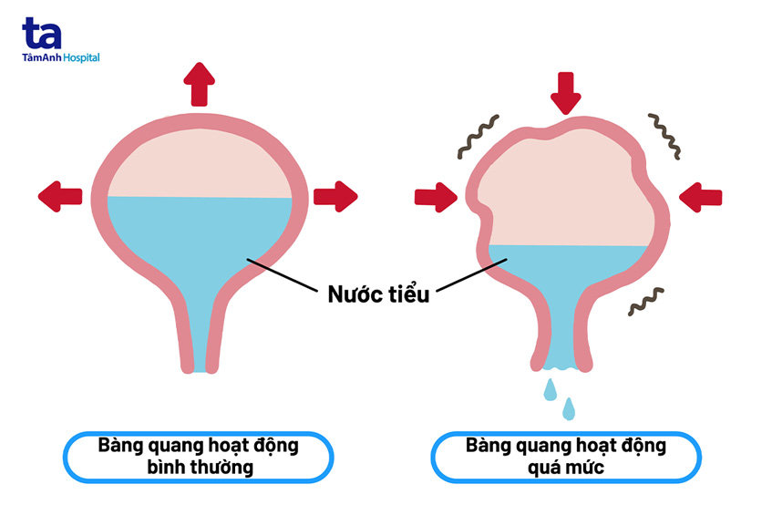 bàng quang hoạt động quá mức