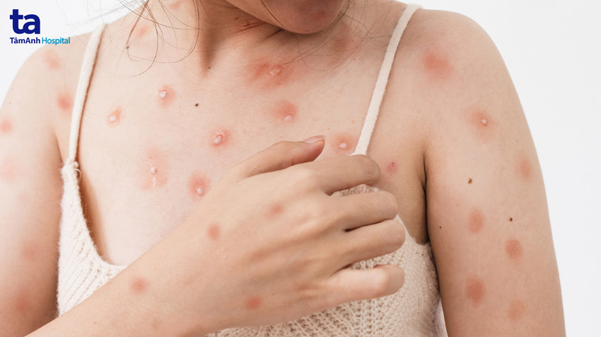 bệnh lây cho hơn 75 quốc gia