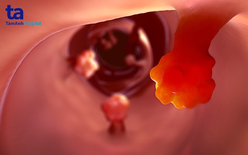 bị bệnh polyp hậu môn