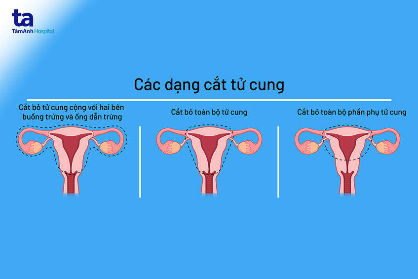 các dạng cắt bỏ tử cung