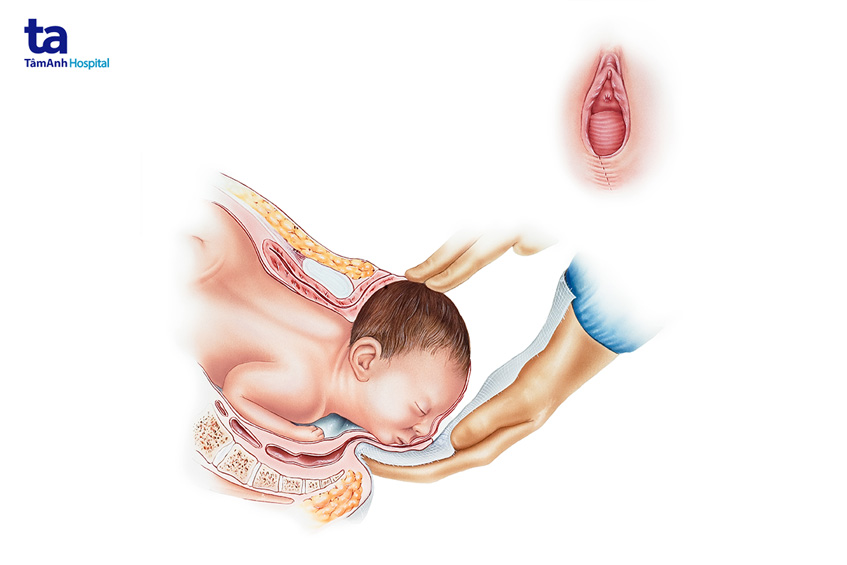 chấn thương trong quá trình sinh nở